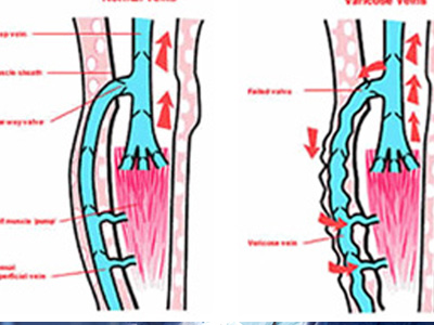 Varicose Veins Treatment in Bronxville